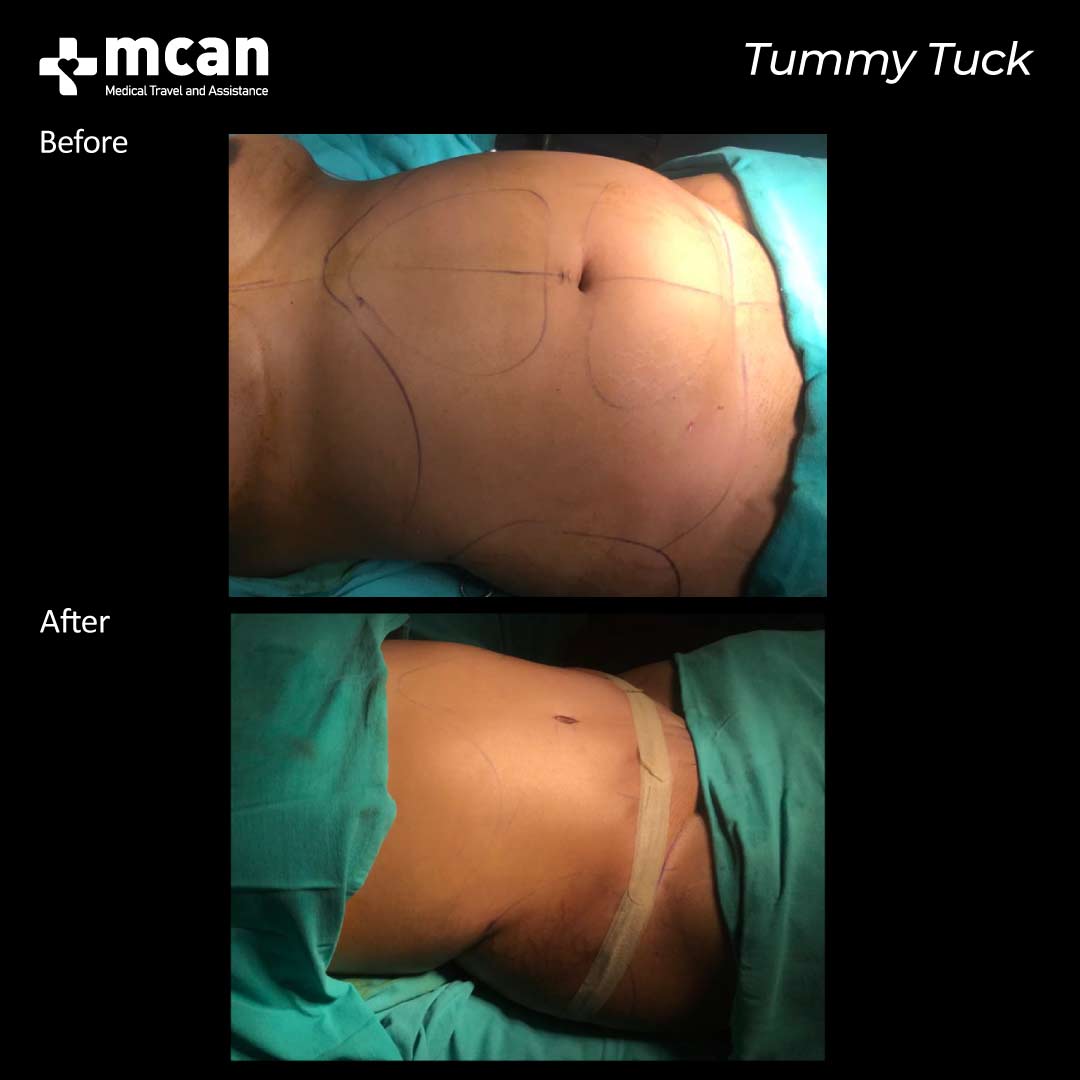 tummy tuck in turkey before after 0607202101