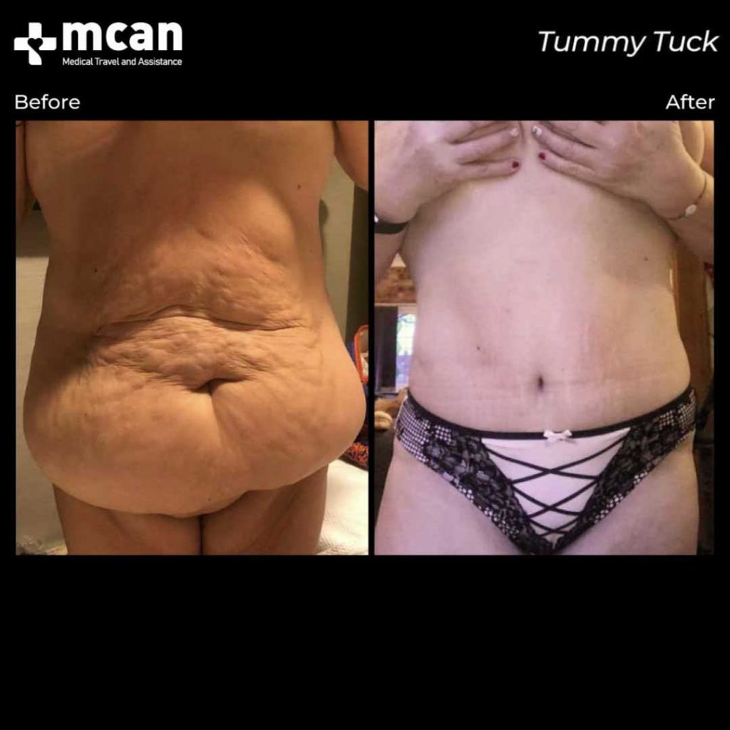 tummy tuck turkey before after mcan health 3