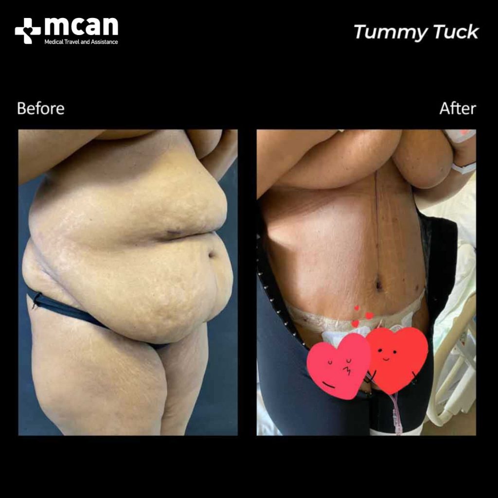 tummy tuck turkey before after mcan health 4