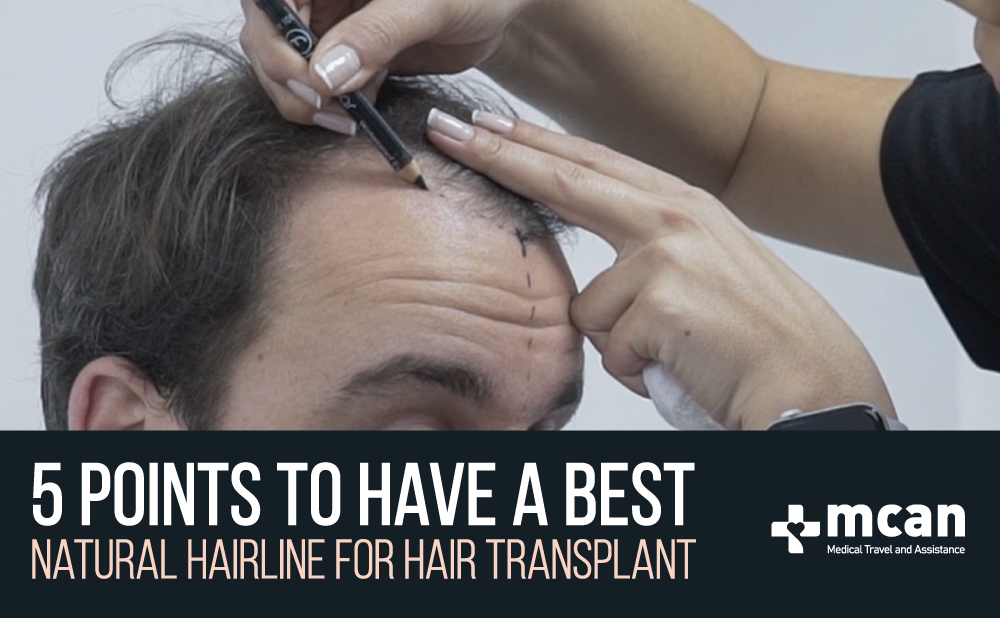 Best Natural Hairline for Hair Transplant