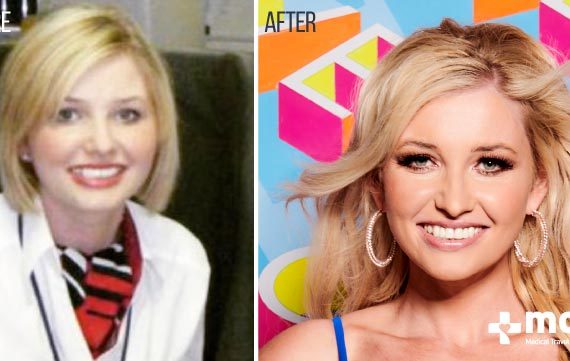 Love Island Plastic Surgeries in 2021 Reunion