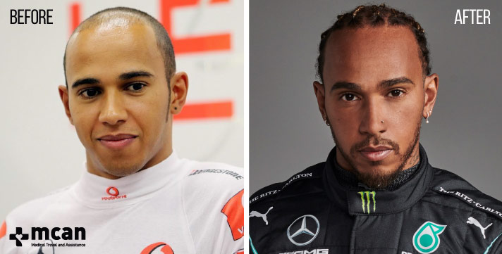 hair transplant celebrities before and after Lewis Hamilton