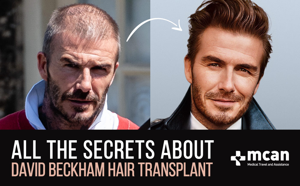 All the secrets about David Beckahm Hair Transplant