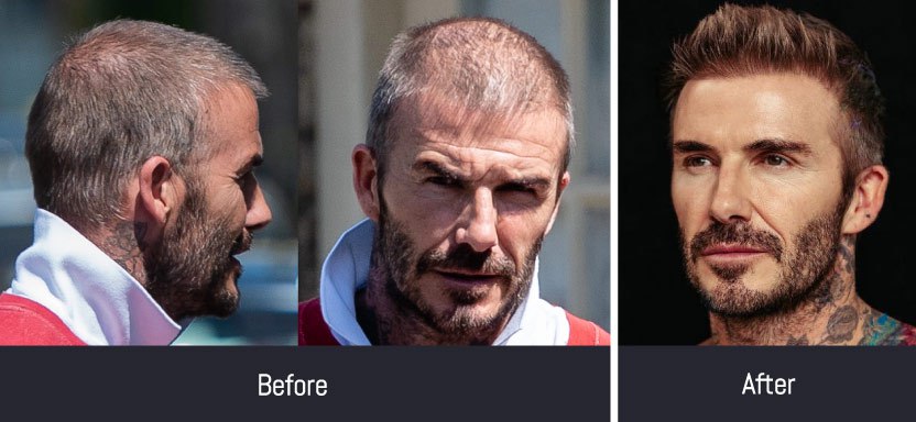 David Beckham Before and After Hair Transplant 