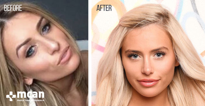 Before and after plastic surgery Ellie Brown | MCAN Health