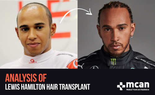 Lewis Hamilton Hair Transplant Analysis | MCAN Health