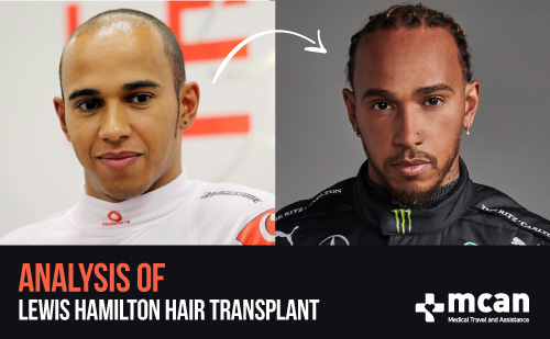 The Whole Story about Lewis Hamilton Hair Transplant! The Whole Story about Lewis Hamilton Hair Transplant!