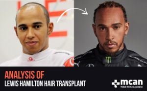Lewis Hamilton Hair Transplant Analysis | MCAN Health