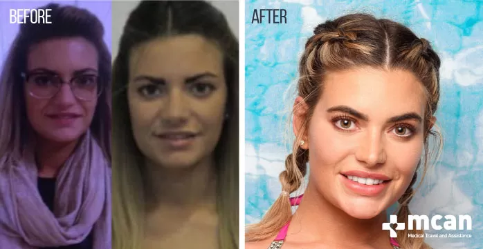 Love Island Reunion 2021: Before and After of Plastic Surgeries 12 Megan Barton Hanson Before After Megan love island before surgery