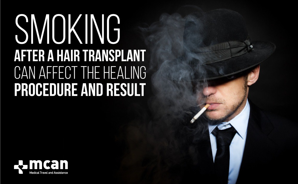Smoking After Hair Transplant Affects the Result