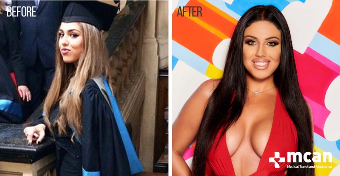 Anna Vakili Love Island Before and After | MCAN Health