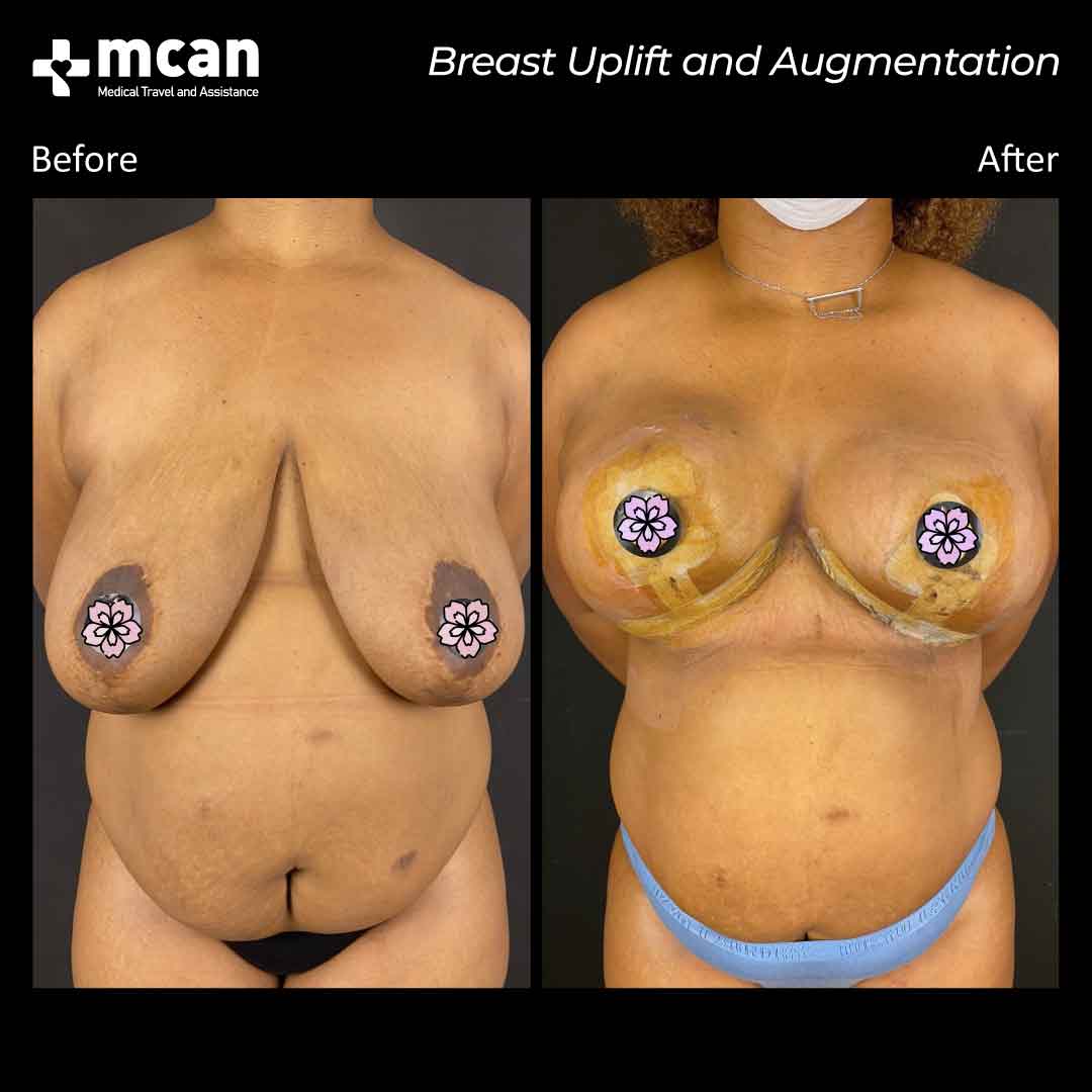 breast uplift and breast augmentation turkey before after 0109202101