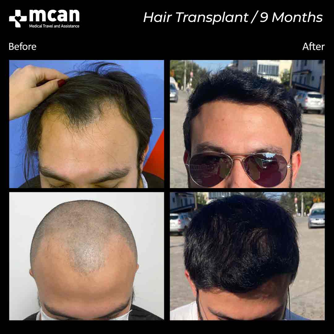 Hair Transplantation Before and After - MCAN Health Hair Transplantation Before and After - MCAN Health