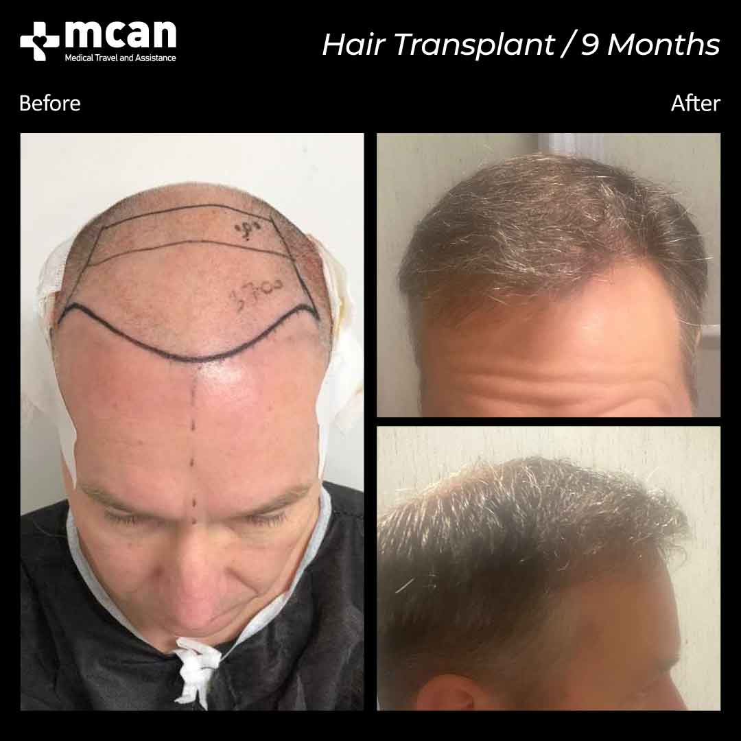Hair Transplant Turkey Before After | MCAN Health