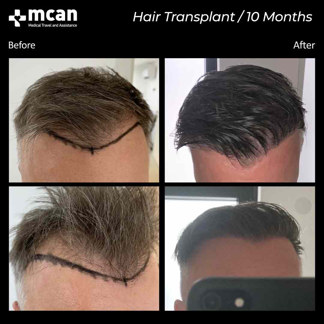 Why is Turkey the Most Advantageous Destination for Hair Transplant? »  Residence Style