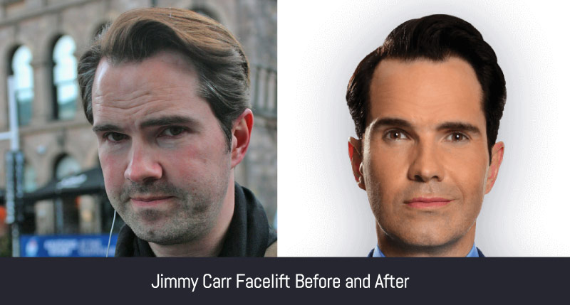 Jimmy Carr Before and After Facelift 