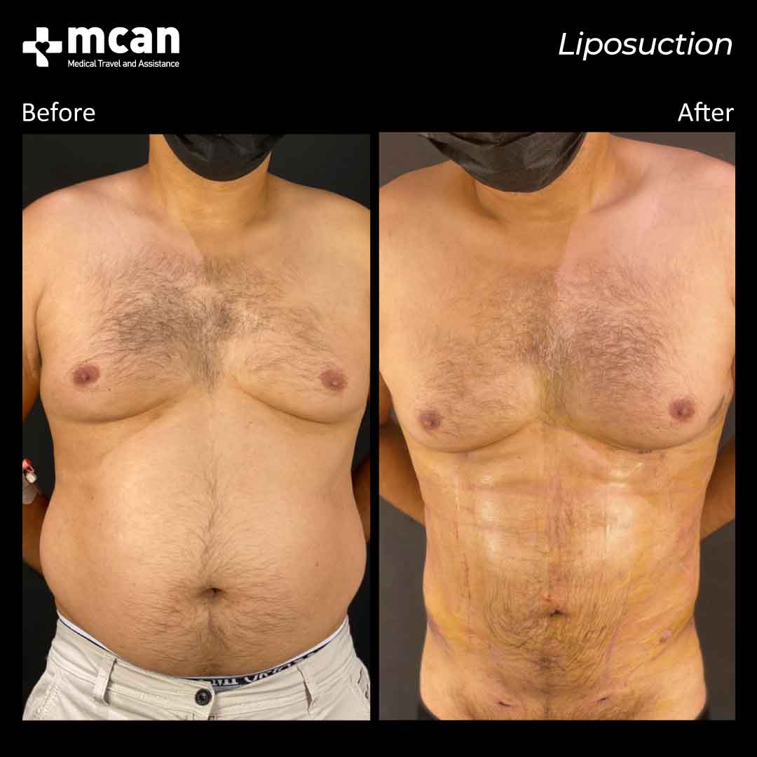 liposuction turkey before after 0109202101