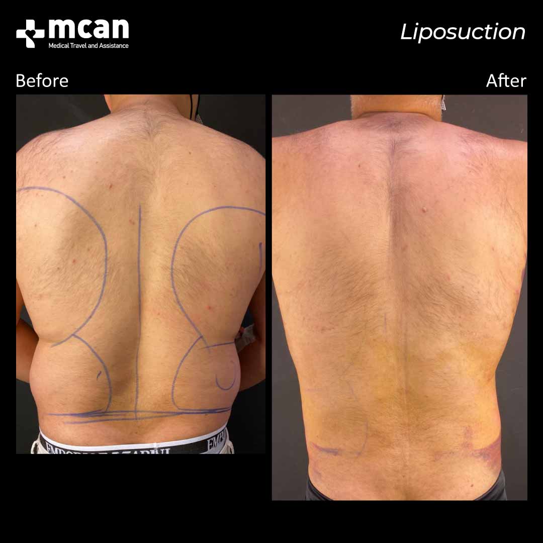 liposuction turkey before after 0109202102