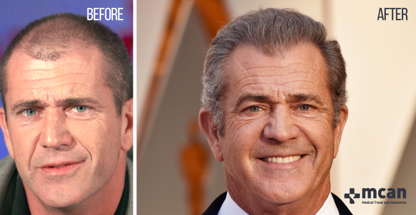 Mel Gibson trasplante capilar | MCAN Health Turquía