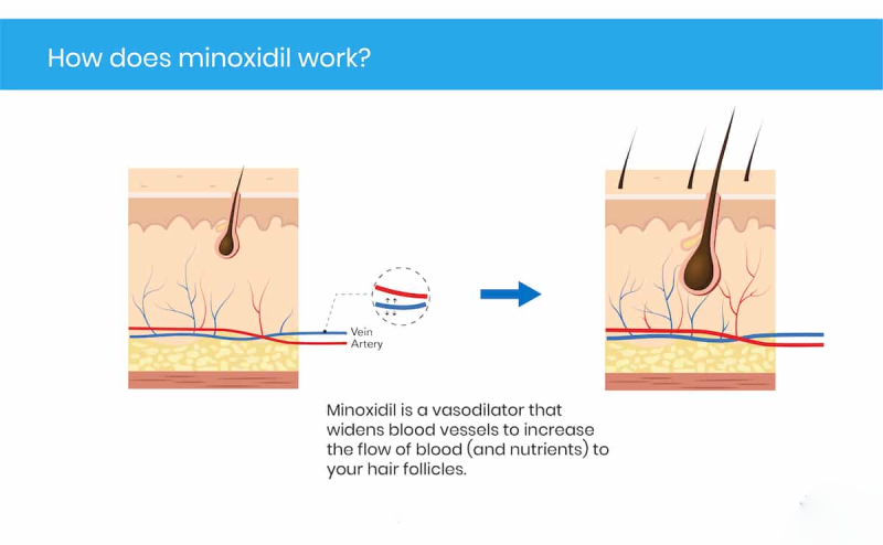 minoxidil after hair transplant