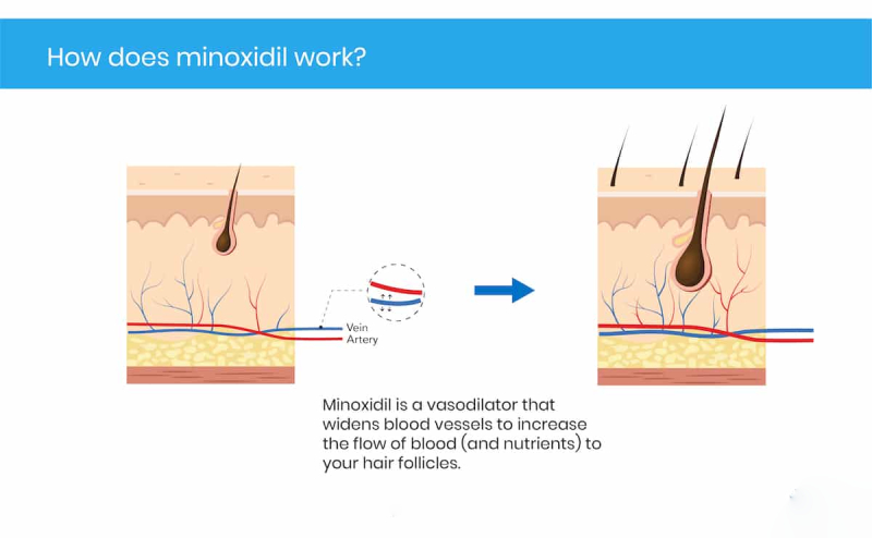 stopping minoxidil minoxidil after hair transplant