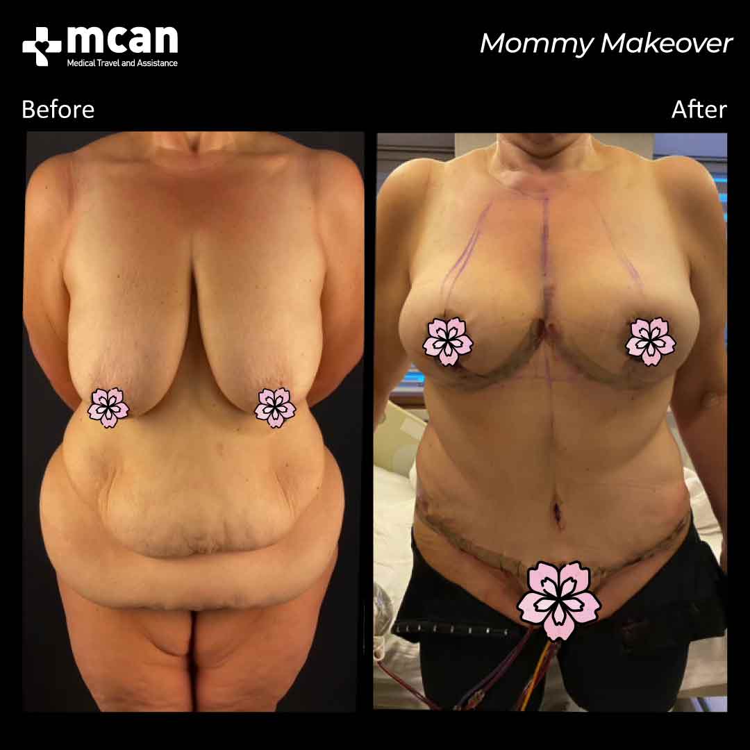 mommy makeover turkey before after