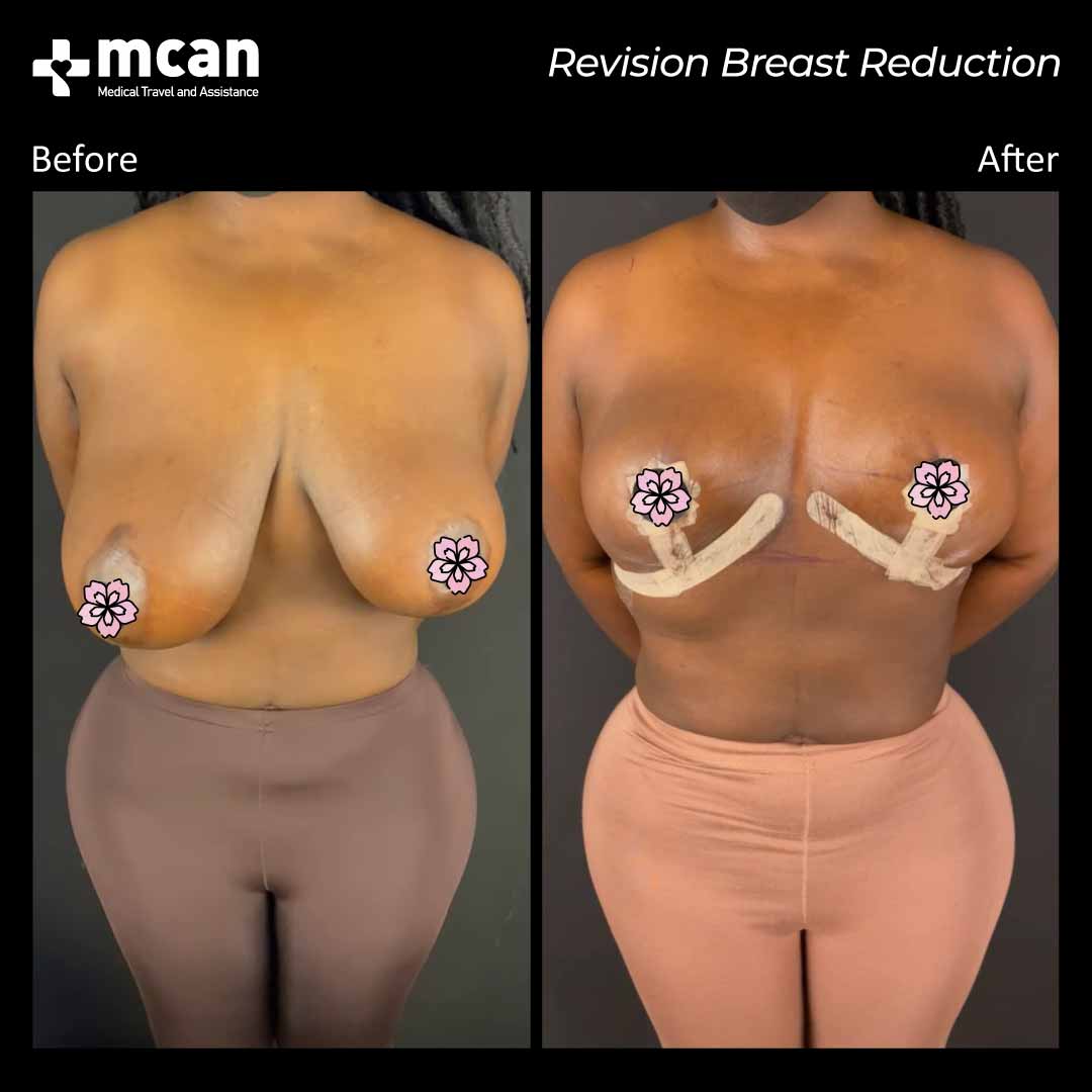 breast reduction turkey before after