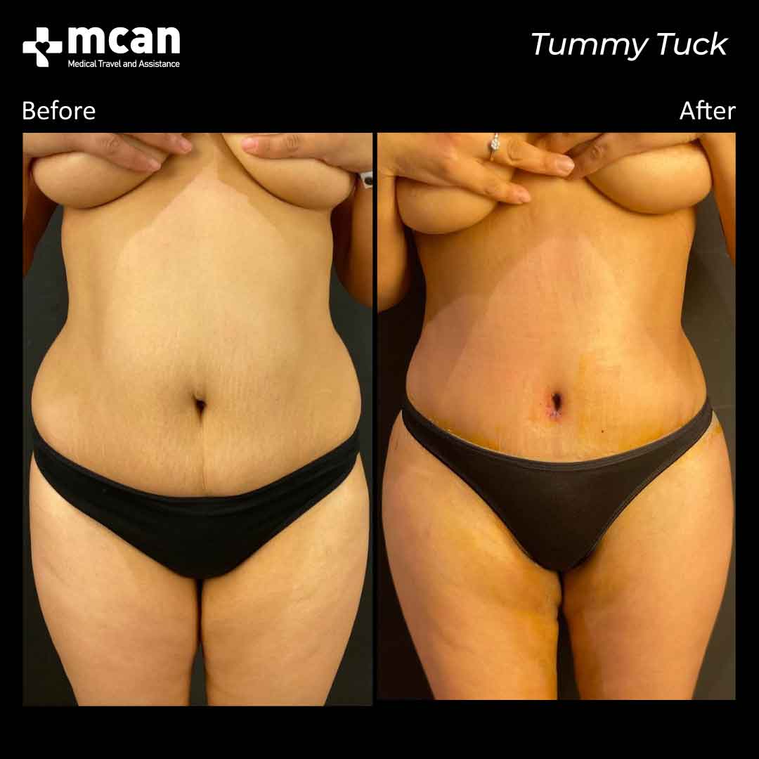 tummy tuck turkey before after 0109202101