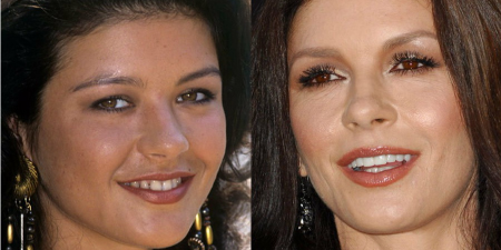 Catherine Zeta Jones: before and after Hollywood Smile | MCAN Health