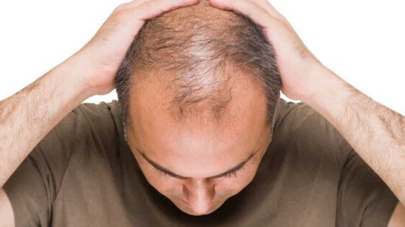 Balding and Hair Thinning, What Are the Best Hair Loss Treatments 4 Hair loss treatments e1656748931366 Hair loss treatments e1656748931366