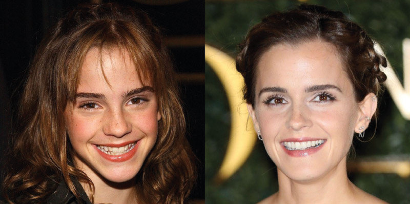 Everything you need to know about Hollywood Smile 3 Hollywood Smile GORSEL2 Hollywood Smile Celebrities