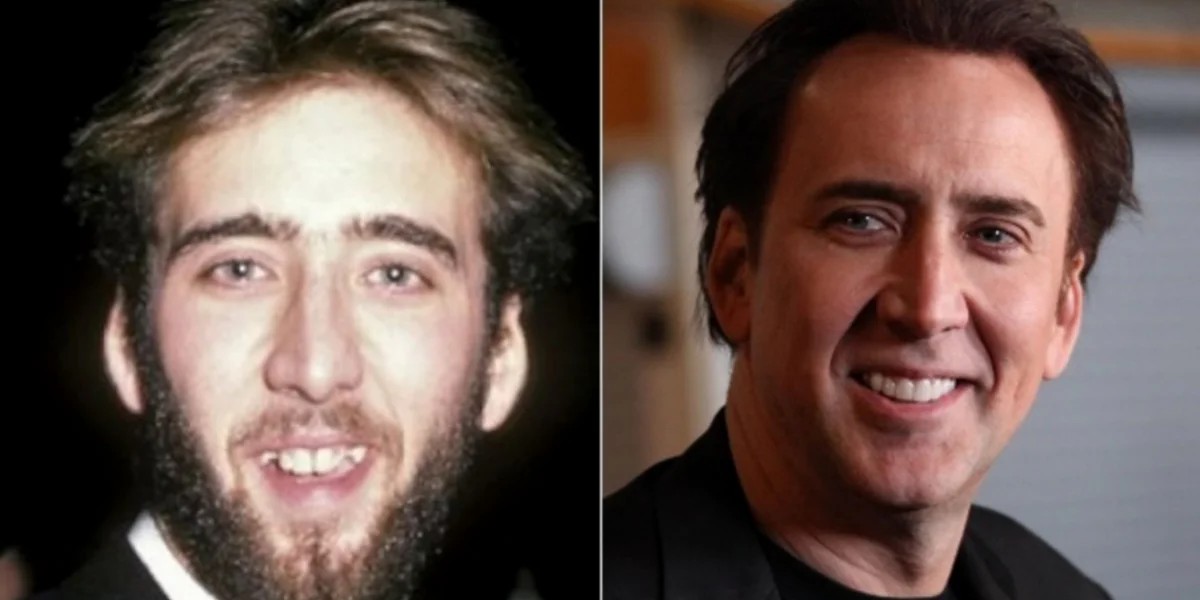 Niclas Cage: Hollywood Smile procedure before and after | MCAN Health Turkey