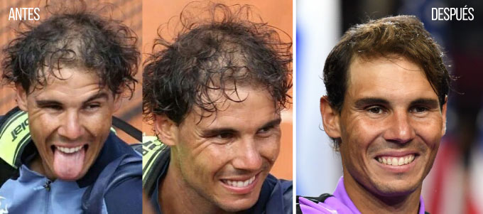 Antes y después del cabello de Rafa Nadal | MCAN Health