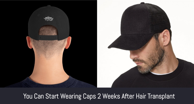 wait two weeks before wearing cap after hair transplant