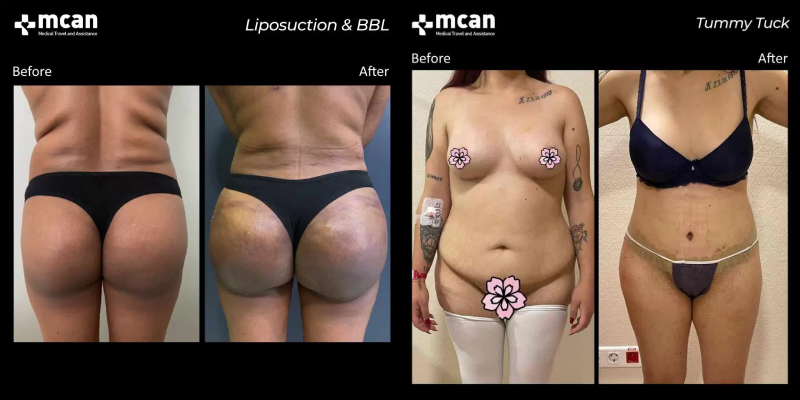 BBL and Tummy tuck with Mcan Health 