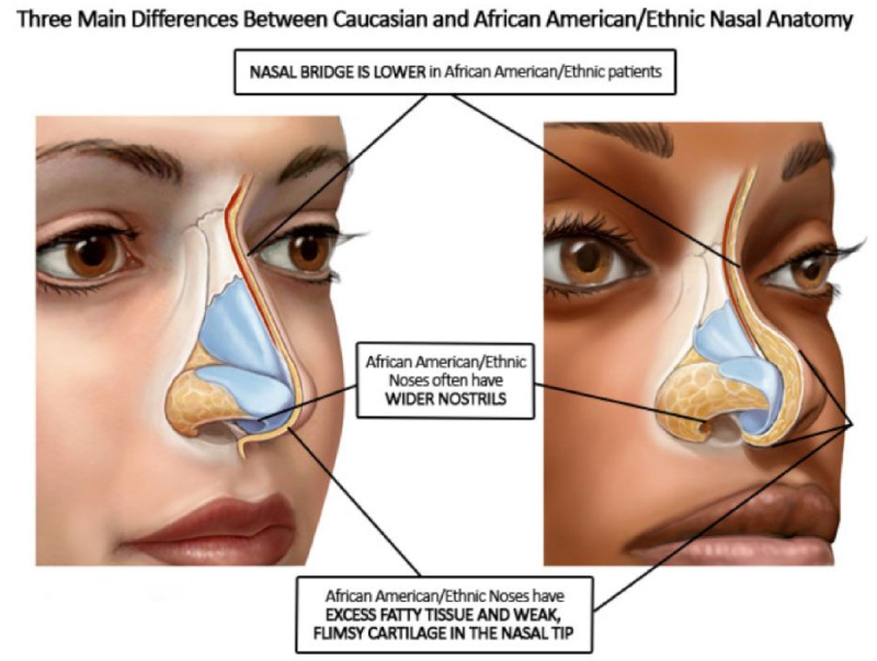 difference between caucasian nose and african nose
