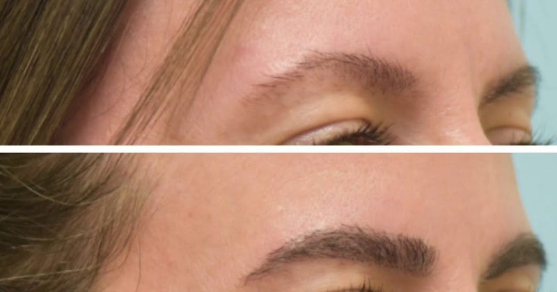 eyebrow transplant before and after 