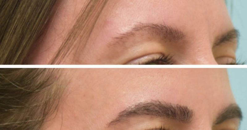 eyebrow transplant before and after eyebrow transplant before and after