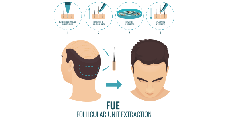 Balding and Hair Thinning, What Are the Best Hair Loss Treatments 6 hair transplant methods fue e1656749285847 hair transplant methods fue e1656749285847