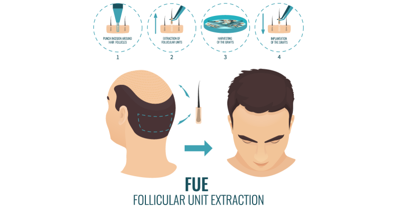 hair transplant methods fue e1656749285847