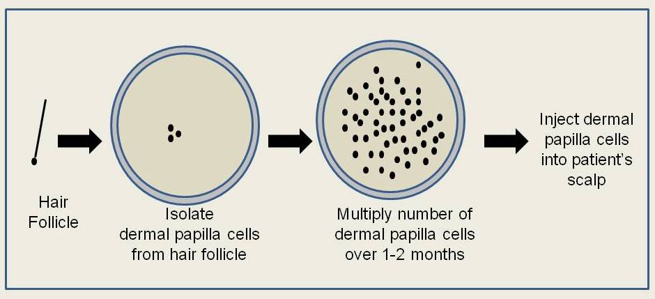 Balding and Hair Thinning, What Are the Best Hair Loss Treatments 8 haircloning Hair Cloning