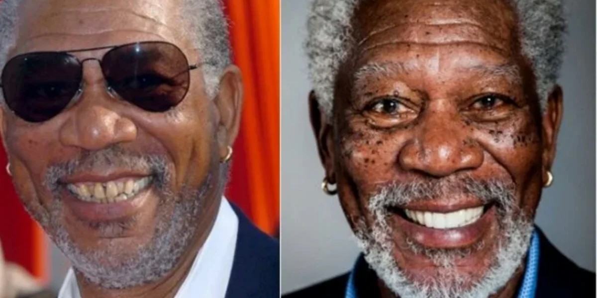 Morgan Freeman before and after dental makeover | MCAN Health Turkey