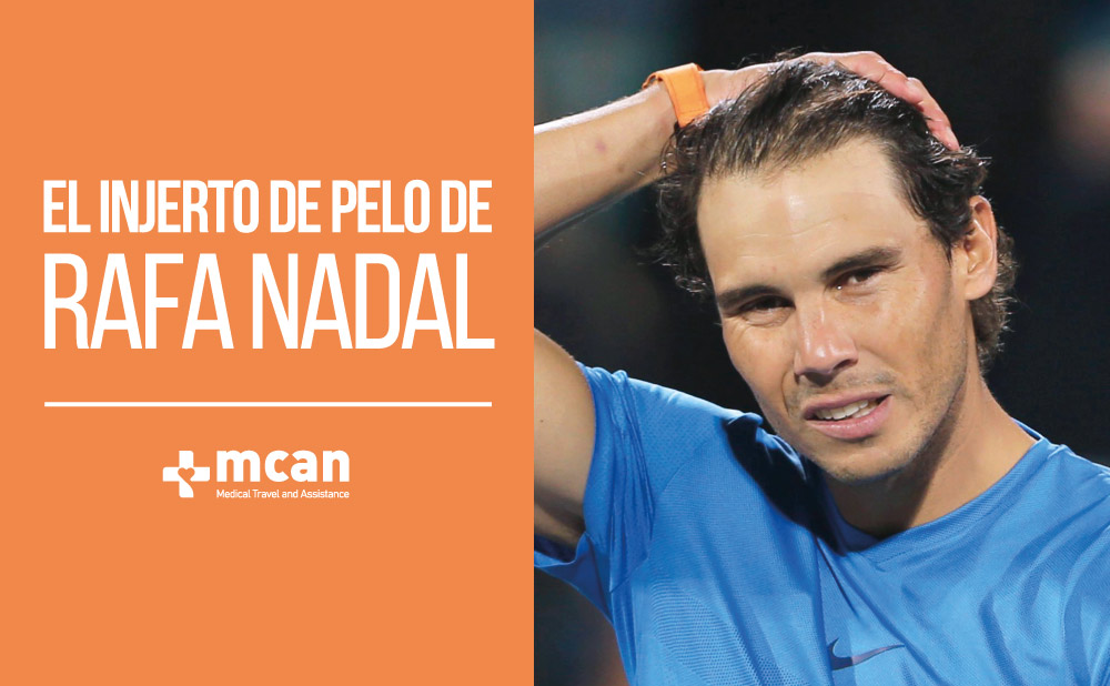 Injerto de pelo de Rafa Nadal | MCAN Health blog