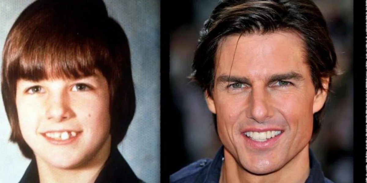 Tom Cruise teeth, before and after treatment | MCAN Health Turkey