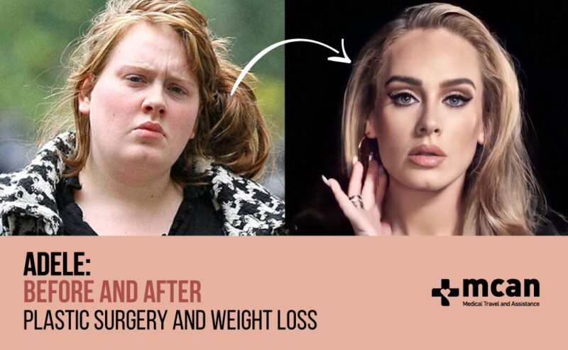 Adele Before and After Her Transformation | MCAN Health Adele Before and After Her Transformation | MCAN Health
