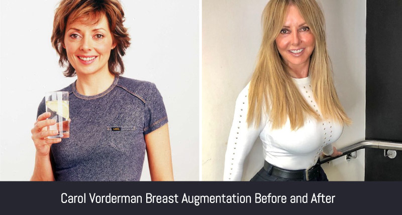 Carol Vorderman before and after breast enlargement 