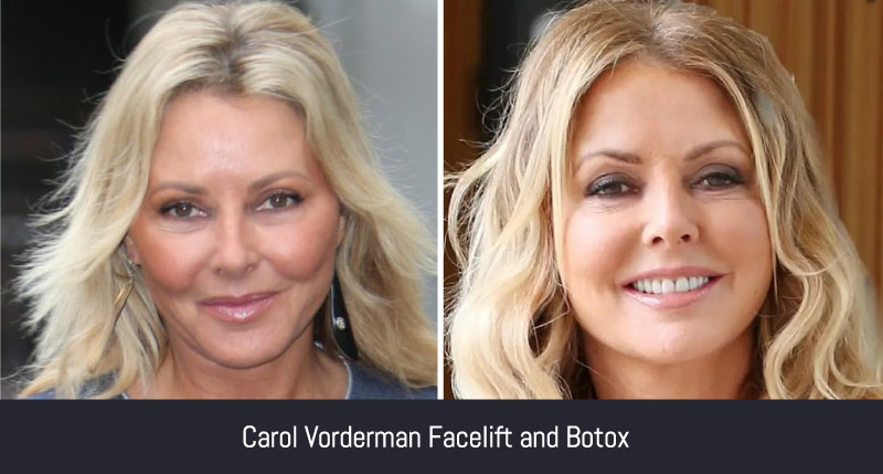 Carol Vorderman facelift and botox