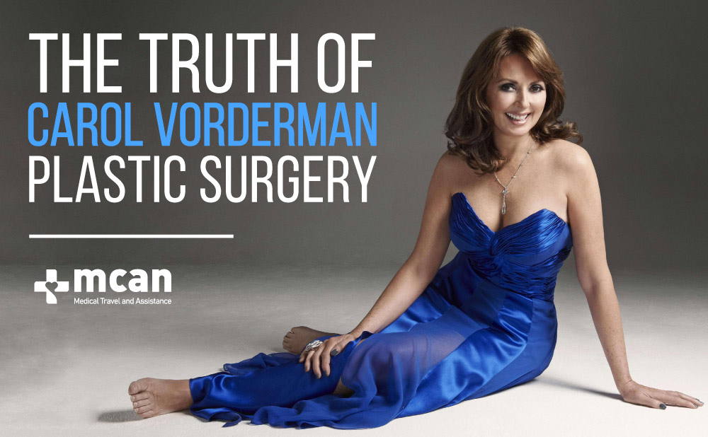 The Truth of Carol Vorderman Plastic Surgery
