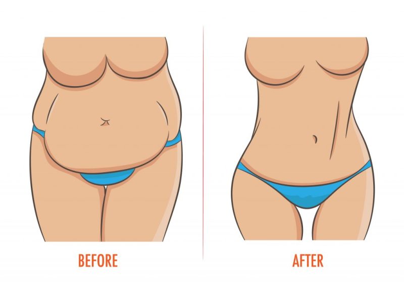 lipo belly button