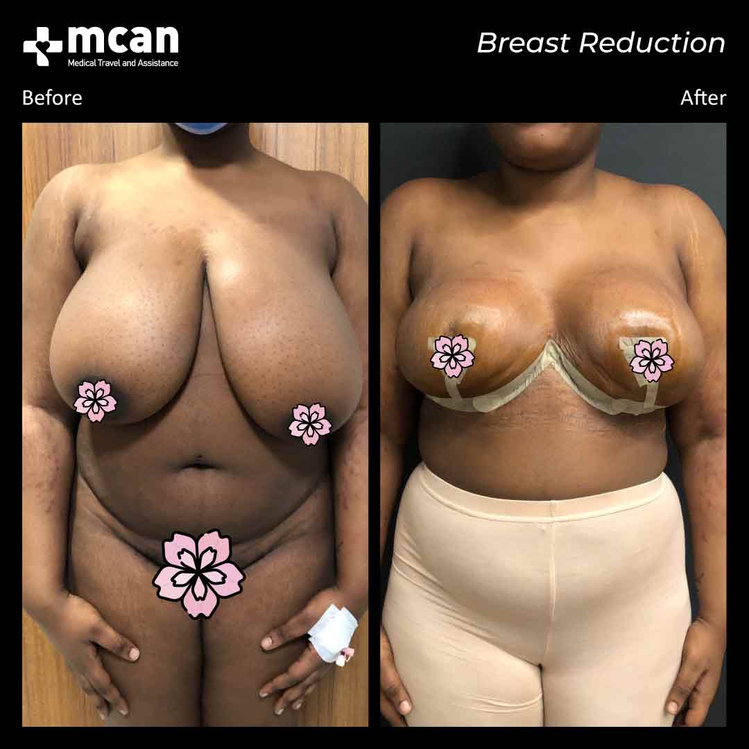 adeola breast reduction